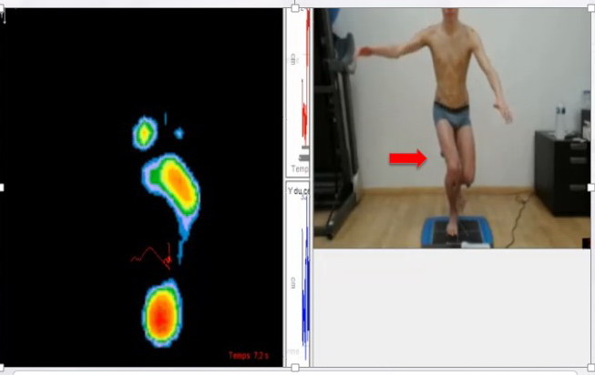 lombalgie douleur lombaire dos rachis kiné du sport montpellier analyse posturale course a pied