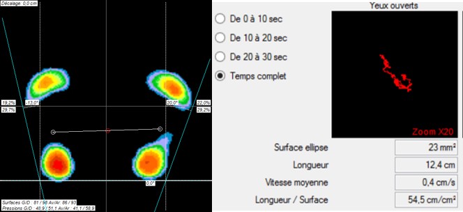 course à pied blessure du sportif analyse mouvement prévention Montpellier kiné du sport lombalgie chronique douleur tendinopathie